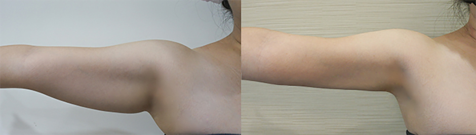 瘦手臂,雷射減脂,贅肉,掰掰袖